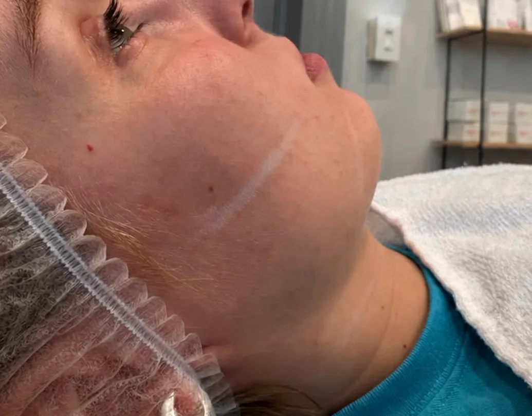 Facial Contouring — before